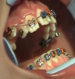 Colors for braces for orthodontics in Lilburn, GA