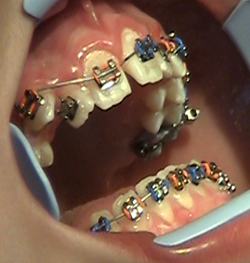 Orthodontics › Killian Hill Dental Care - Lilburn, GA