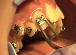 Placing braces for orthodontics in Lilburn, GA