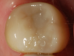 Crown Covering Fractured Tooth