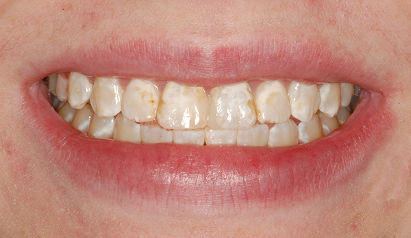 Bonding to Cover Discolorations Before Smile