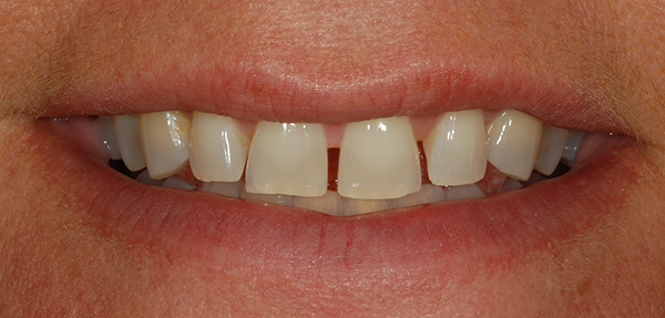 Porcelain Veneers to Cover Spaces Before Smile