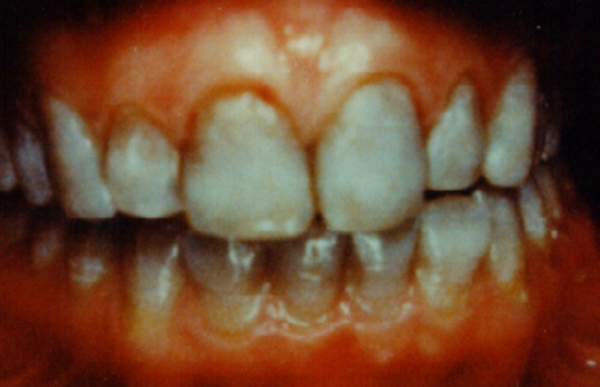 Teeth stain from tetracycline