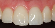 Bonding to Cover Discolorations After Closeup