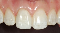 Central Incisor Crown After Closeup