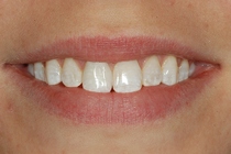 Porcelain Crown Covers a Discolored Tooth - After
