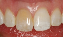 Central Incisor Crown Before Closeup