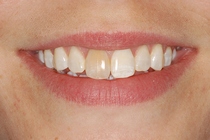 Porcelain Crown Covers a Discolored Tooth - Before