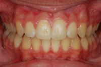 Orthodontic Overbite After Front