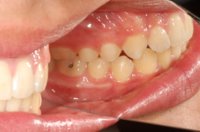 Orthodontic Overbite After left