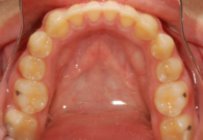 Orthodontic Overbite After Lower