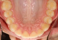 Orthodontic Overbite After Upper