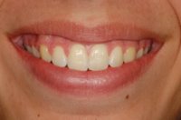Orthodontics For Bad Overbites - After