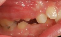 Orthodontic Overbite Before Left