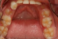 Orthodontic Overbite Before Lower