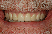 Implant Supported Denture Smile