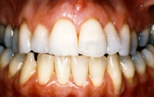 Teeth Bleaching - After