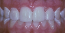Bonding To Widen Small Teeth And To Close Gaps - After