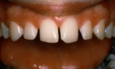 Bonding To Widen Small Teeth And To Close Gaps - Before