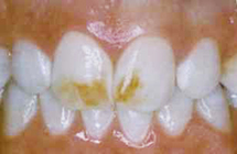 Bonding To Cover Discolorations - Before