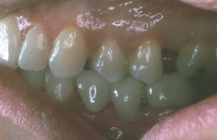 Replacement Of Missing Teeth With Fixed Bridges - After