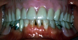 Complete Denture After Front