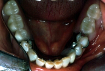 Complete Denture After Lower