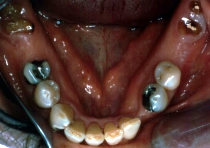 Complete Denture Before Lower