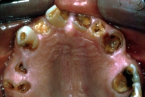 Complete Denture Before Upper