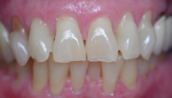 Severe Erosion Corrected With Crowns - Before