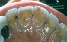 Crowns Erosion Before Upper