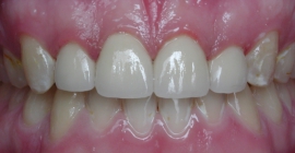 Severe Erosion Corrected With Crowns - After