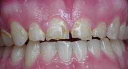 Severe Erosion Corrected With Crowns - Before