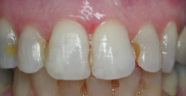 Changing Out Old Discolored Fillings - Before