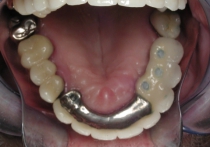 Replacement Of Missing Teeth With Implants - After