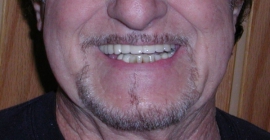 Implants After Smile