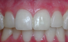 Internal Teeth Bleaching - After