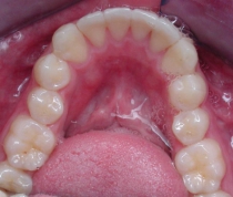 Invisalign - Invisible Braces - After