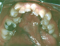 Orthodontics Using Braces - Before