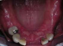 Replacement Of Missing Teeth With Partial Dentures - Before