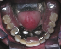 Replacement Of Missing Teeth With Partial Dentures - After