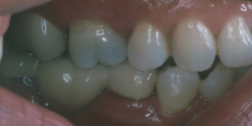 Upright A Severely Tilted Molar And Replace With A Fixed Bridge - After