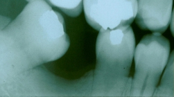 Upright A Severely Tilted Molar And Replace With A Fixed Bridge - Before